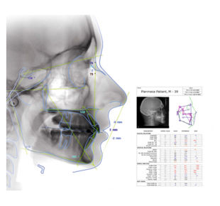 Planmeca Romexis cefalometrická analýza